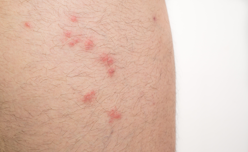 Narben behandeln mückenstich Mückenstich entzündet